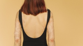 Oparzenia i trudno gojące się rany - co zrobić, gdy rana nie chce się goić?