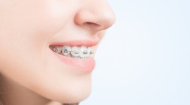 Higiena jamy ustnej przy aparacie ortodontycznym
